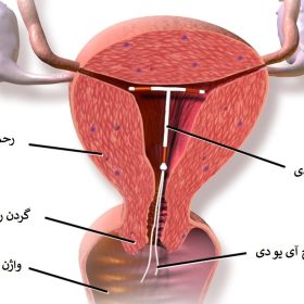 دستگاه داخل رحمی (IUD) برند Pregna