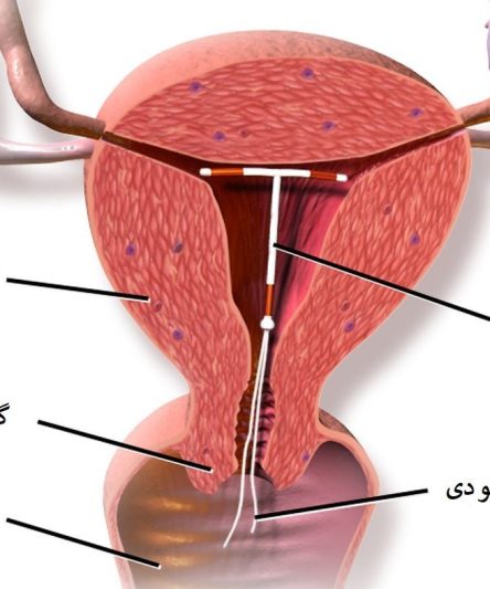دستگاه داخل رحمی (IUD) برند Pregna